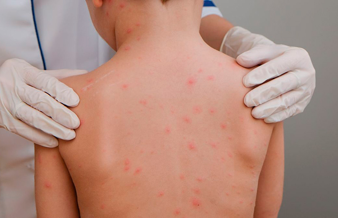 OPS lanza alerta por el sarampión